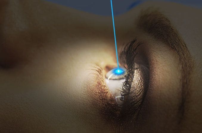 Personalisierte LASIK: Individuelle Sehkorrektur