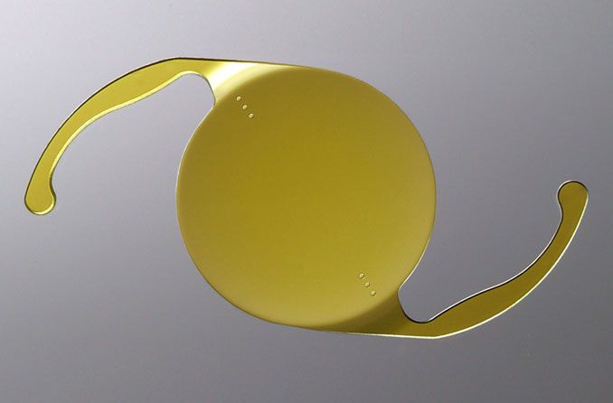 Hornhautverkrümmung und Grauer Star? Eine torische IOL kann beides beheben