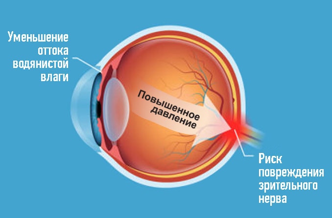 Глазное давление: признаки, симптомы, измерение. Помогут ли капли? - Всё о зрении.