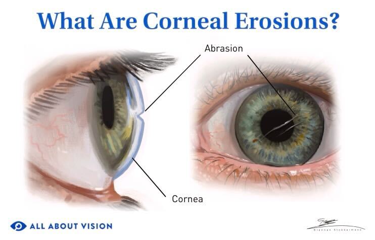 Corneal erosions: Causes, symptoms and treatments Corneal erosions: Causes, symptoms and treatments