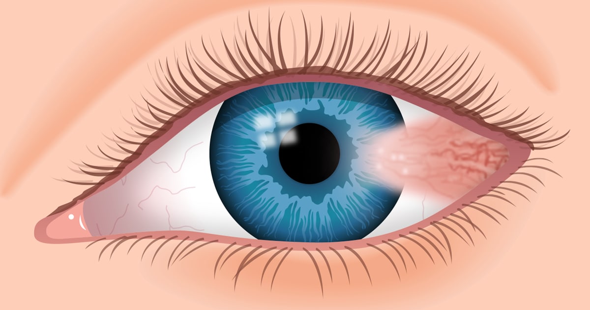 Ilustración de un ojo con ptegirion Ilustración de un ojo con ptegirion