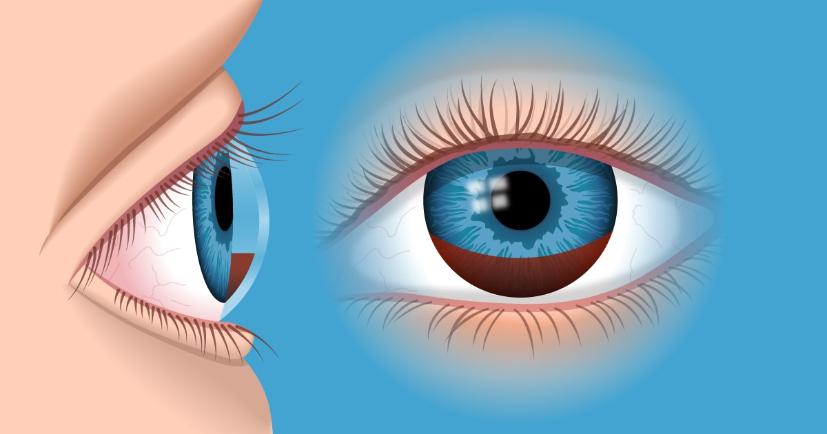 Hifema | Causas de sangre en el ojo | All About Vision