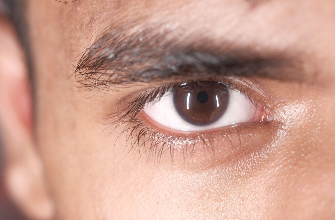 Disfunción de las glándulas de Meibomio (DGM): ¿es la causa de sus ojos secos?