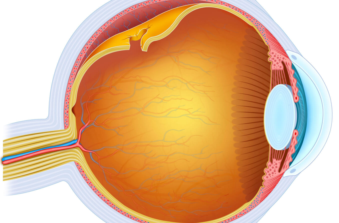 Qué es el desprendimiento de retina | All About Vision
