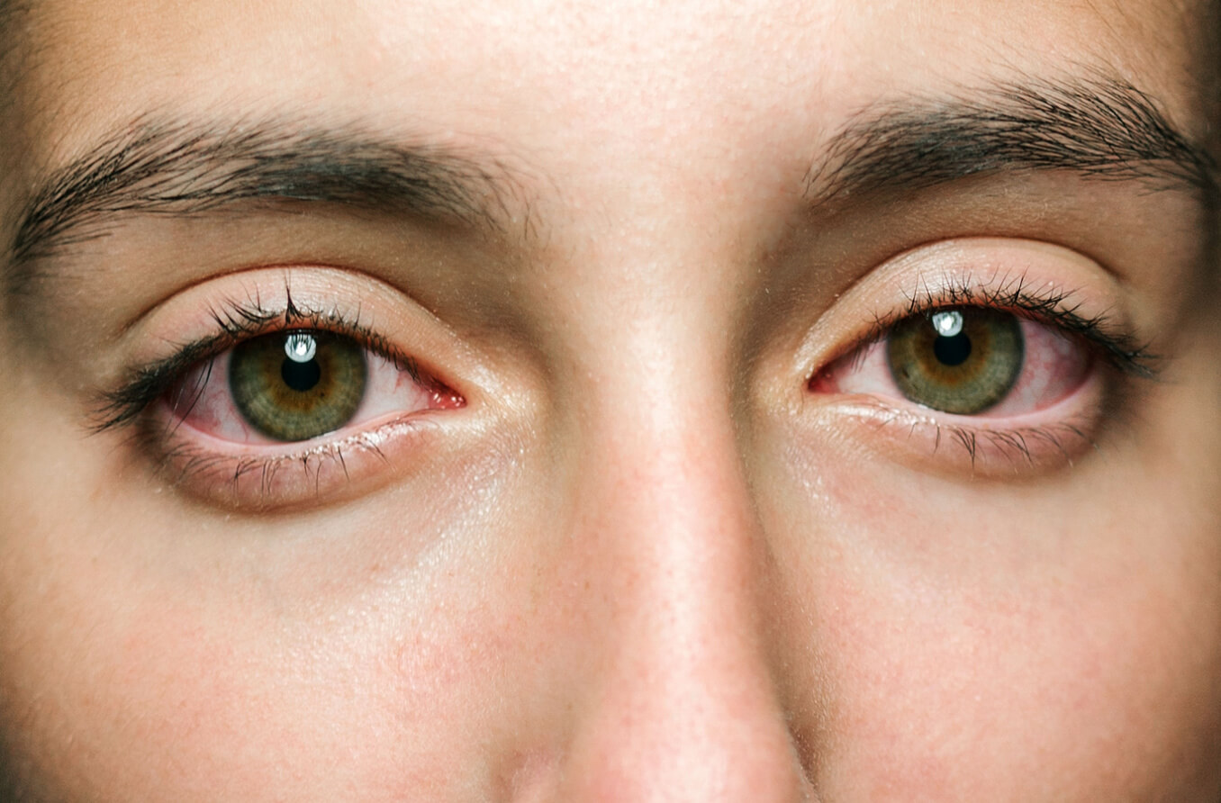Ojos rojos y secos