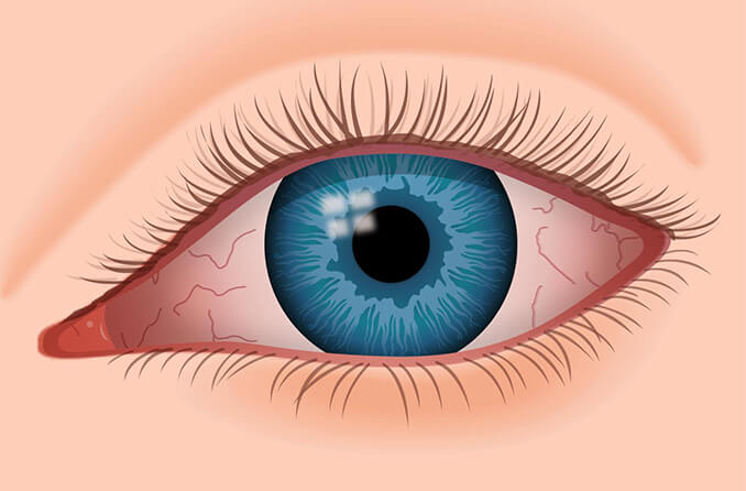 Ilustración de un ojo seco