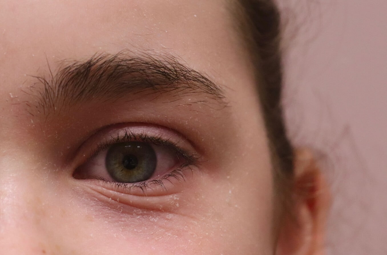 primer plano de la dermatitis del párpado primer plano de la dermatitis del párpado