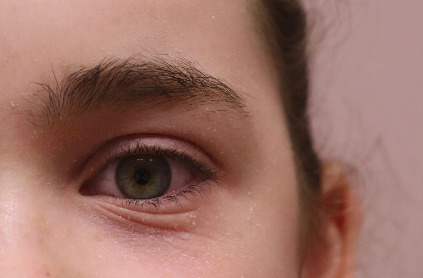 primer plano de la dermatitis del párpado