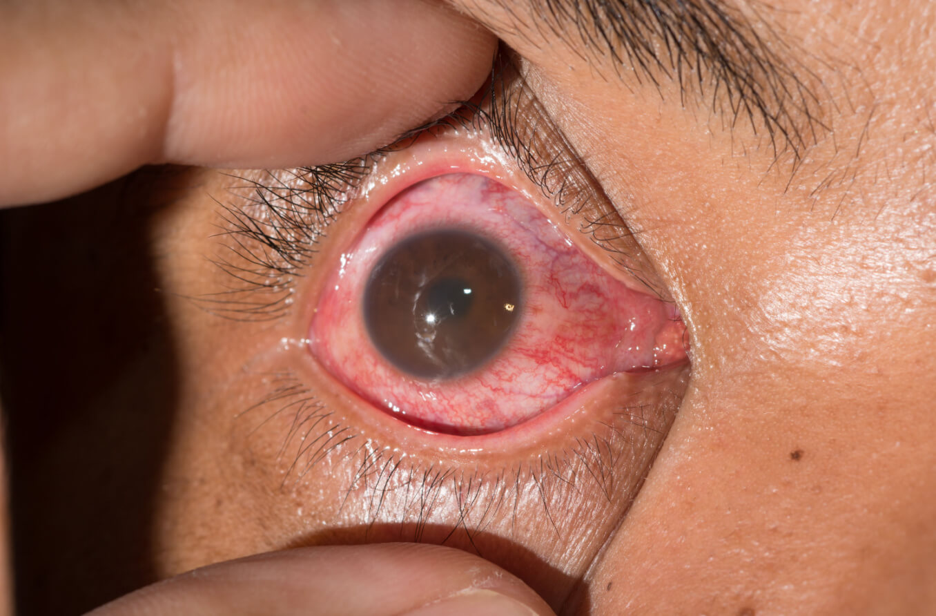 La niña tira del párpado hacia abajo para mostrar un ojo rojo irritado