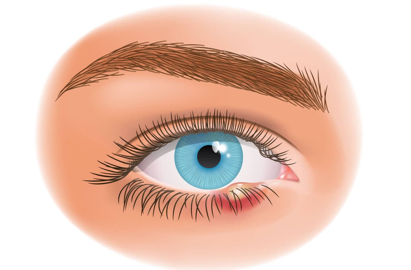 ¿Qué causa un orzuelo (stye) en el ojo?