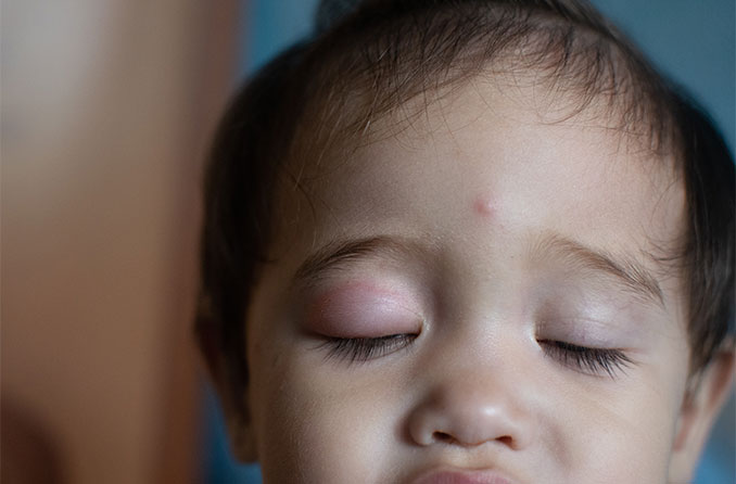 niño con párpado hinchado