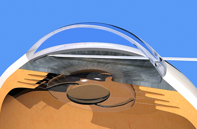 ¿Cuáles son mis opciones para la cirugía de glaucoma?