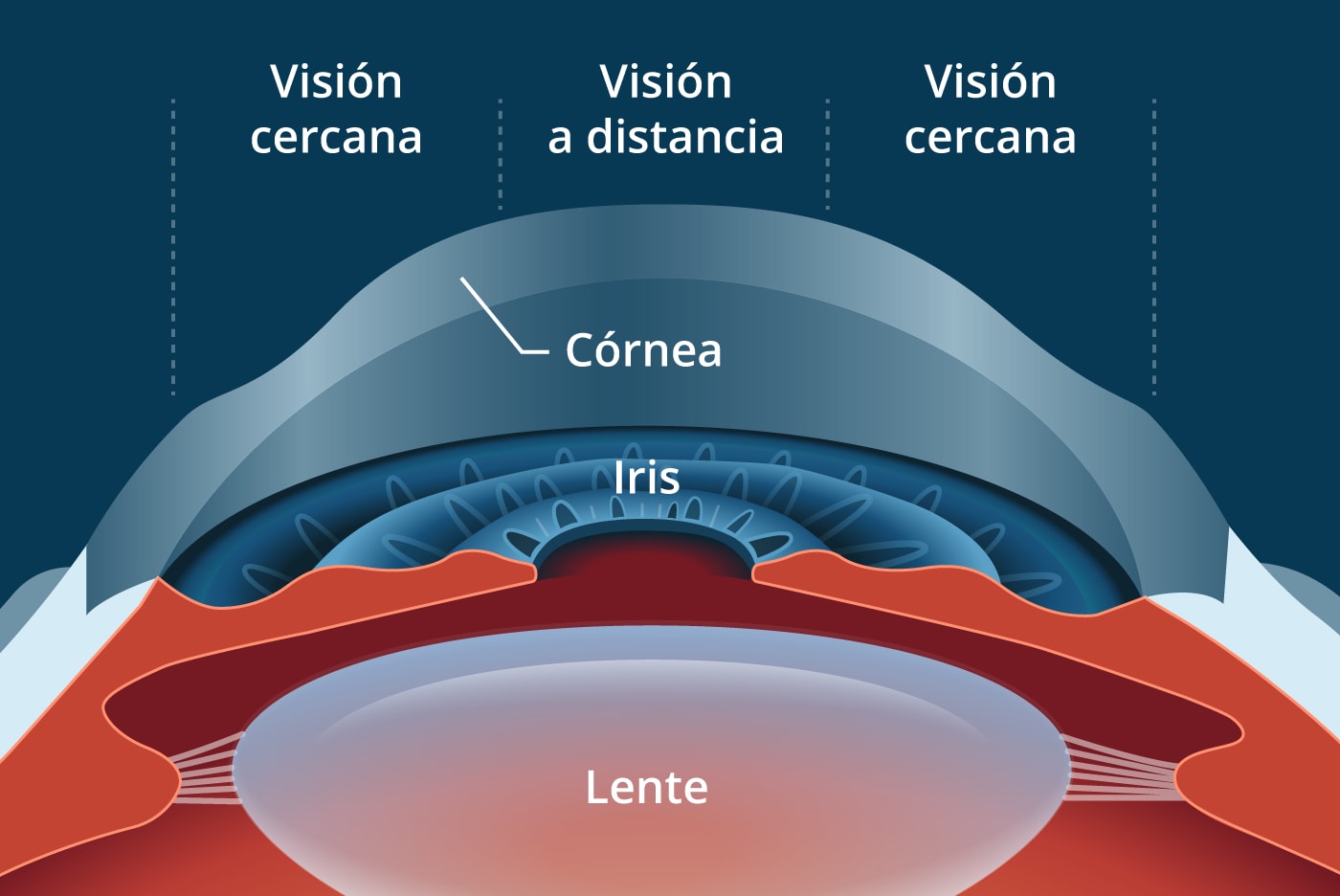 PresbiLASIK: LASIK para la corrección de la presbicia