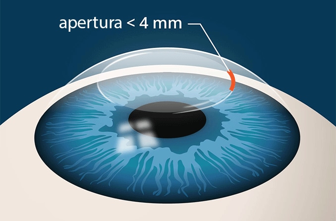 Cirugía ocular SMILE: ¿en qué se diferencia del LASIK? | All About Vision