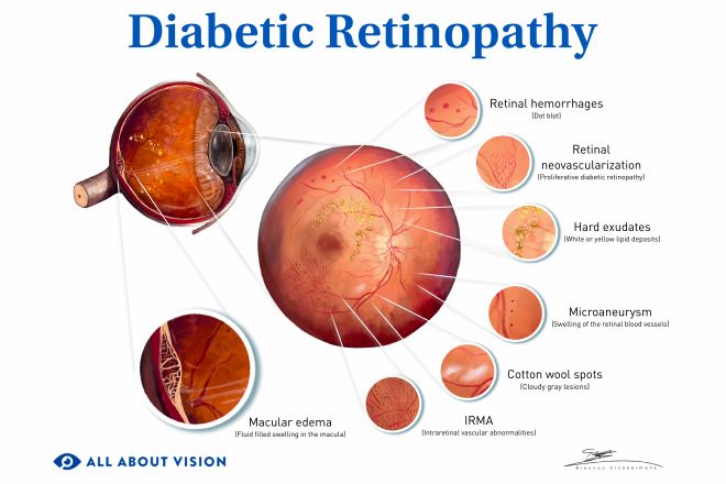 Diabetes-Related Retinopathy: Causes, Treatment, Signs & Symptoms Diabetes-Related Retinopathy: Causes, Treatment, Signs & Symptoms