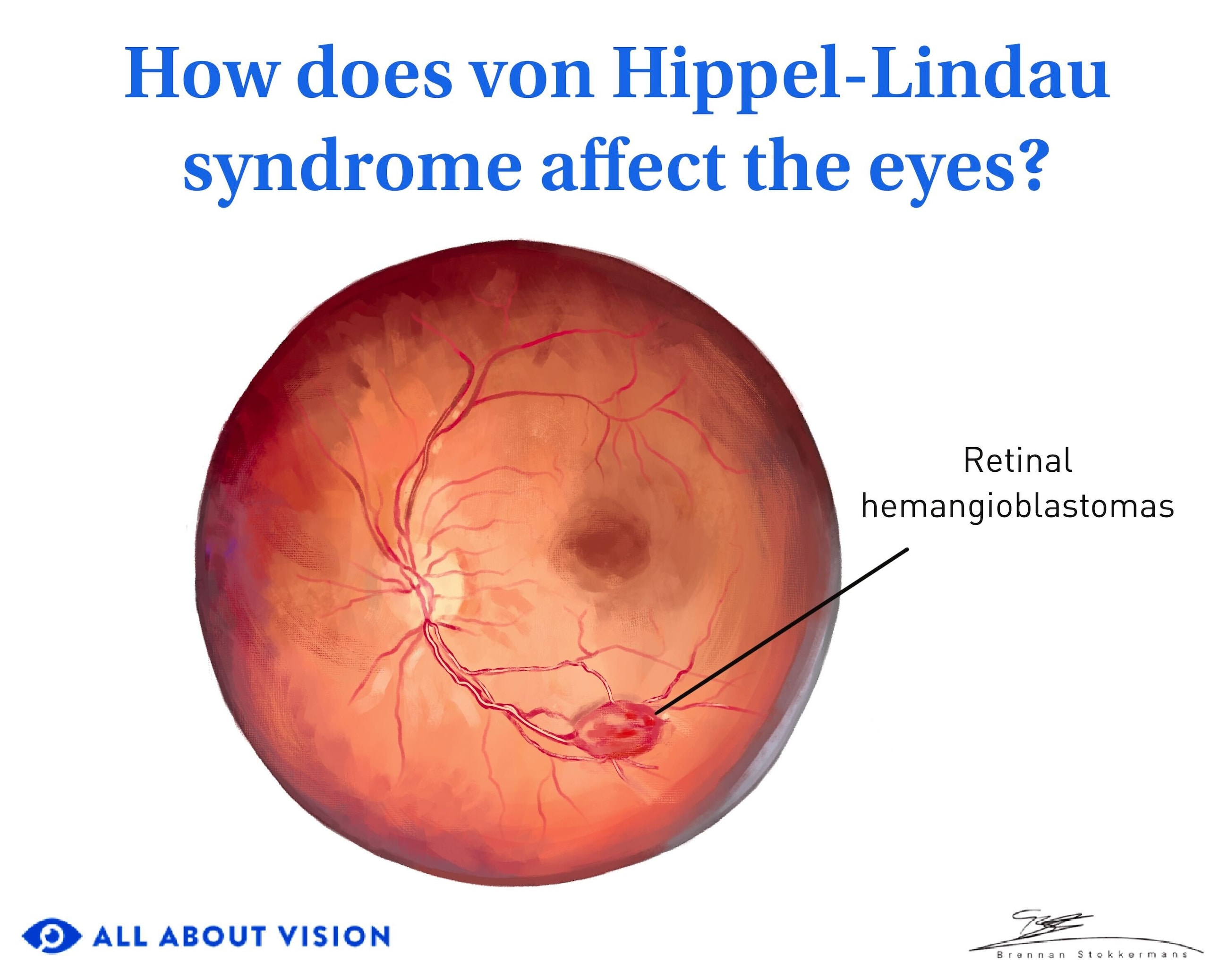Von Hippel-Lindau syndrome and its impact on vision