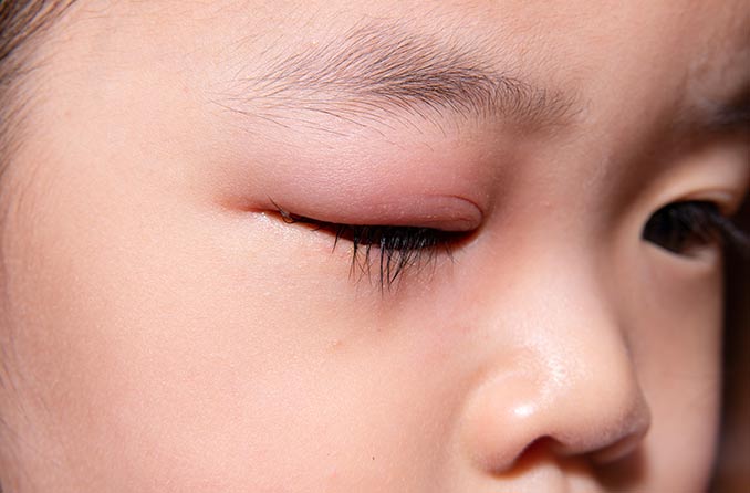 瞼緣炎：眼瞼發炎的原因 | 視力健康網