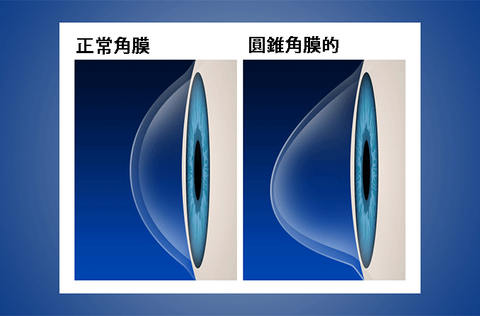 圓錐角膜的10個治療方式：包括成因、症狀