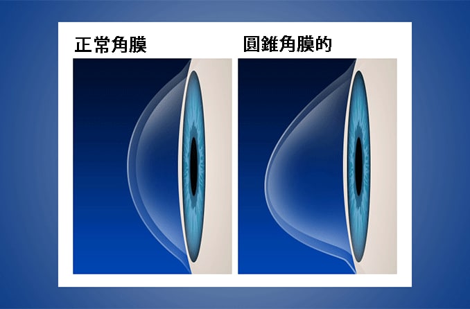 圓錐角膜的10個治療方式:包括成因、症狀
