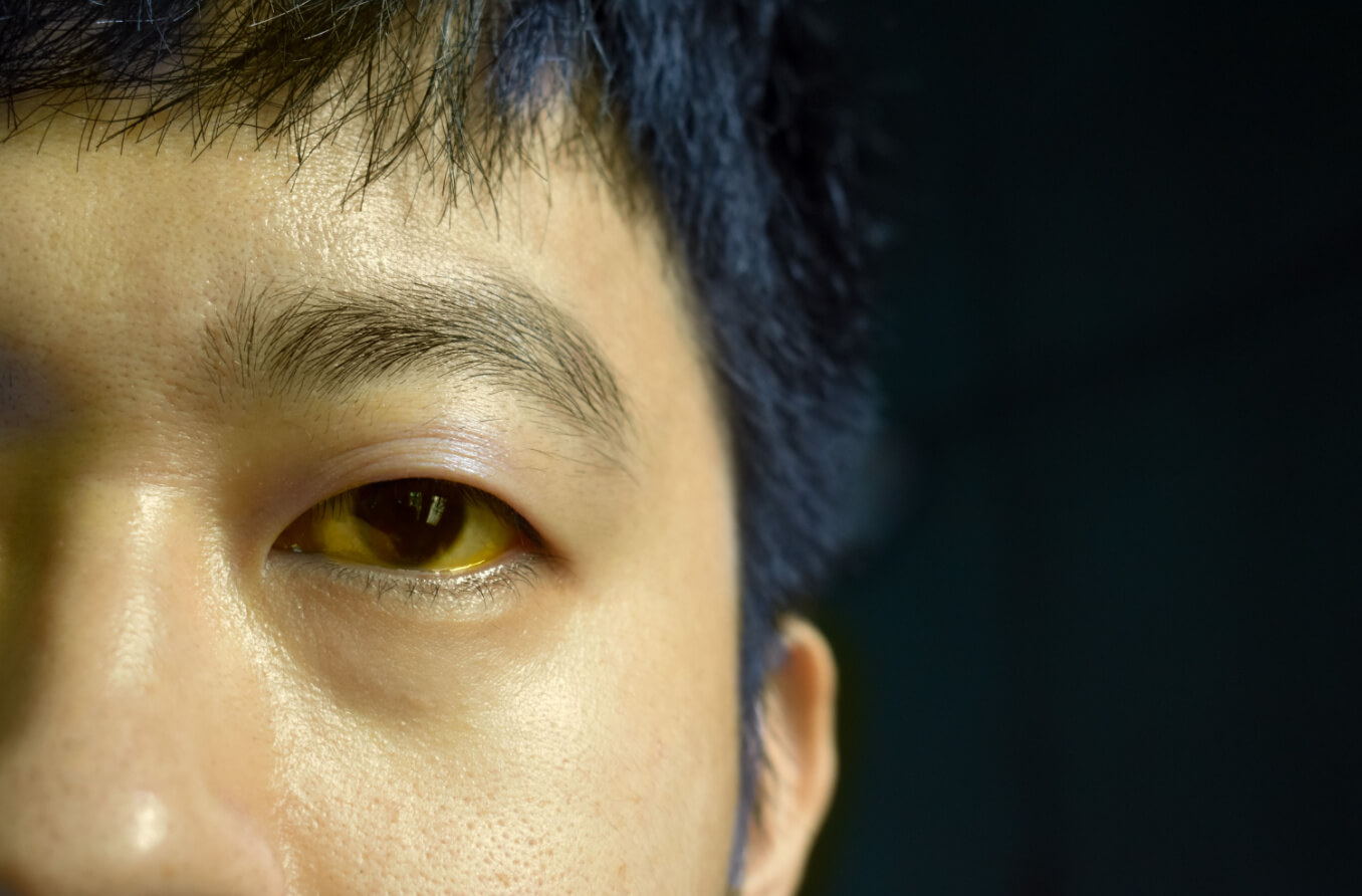眼白泛黃：成因與治療