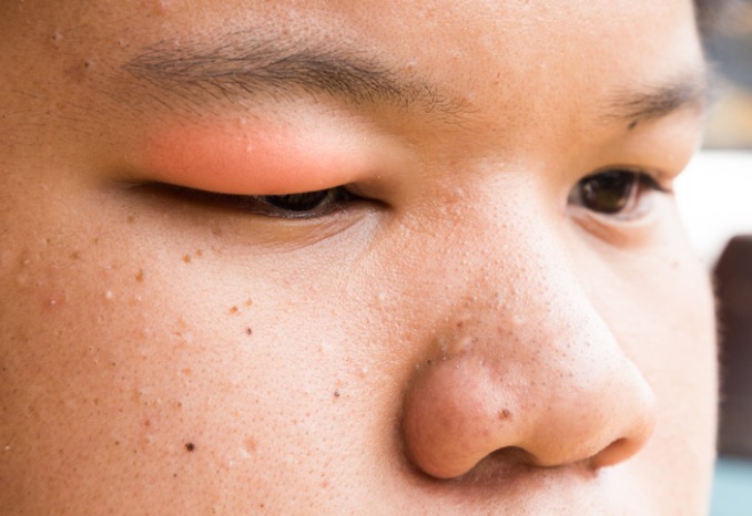 眼瞼腫脹：造成眼瞼腫脹的原因是什麼？