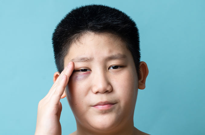 眼周瘀血：如何讓腫脹消退