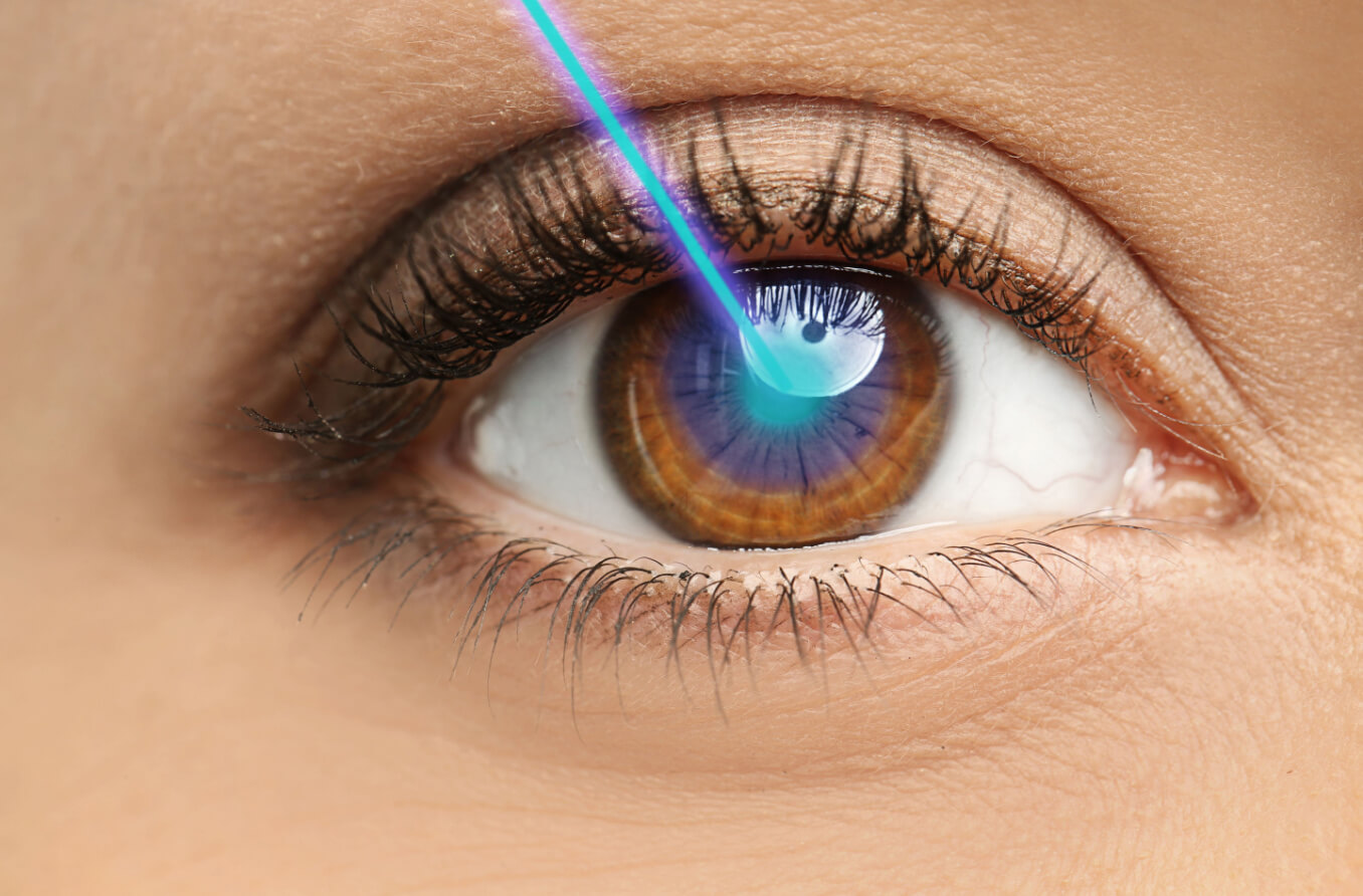 飛秒雷射緩解對 LASIK 的擔憂