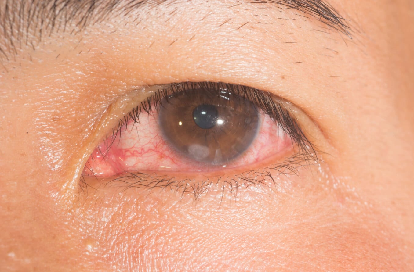 قرحة القرنية: الأسباب، الأعراض، العلاج، مدة التعافي