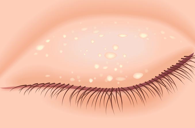 الدخينات: كيفية التخلص من بقعة بيضاء على جفنك