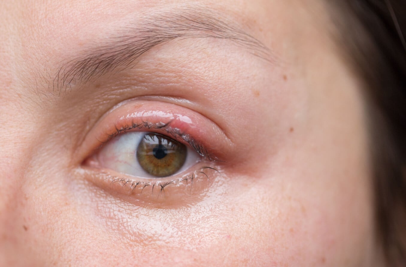 كيفية التخلص من الشَعِيرة: علاجات الشَعِيرة