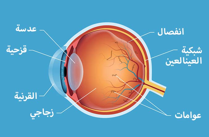 انفصال الجسم الزجاجي والعوامات داخل العين