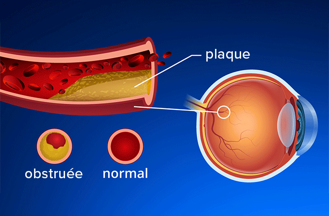 ACV de l’œil : Occlusions de l’artère rétinienne et de la veine rétinienne