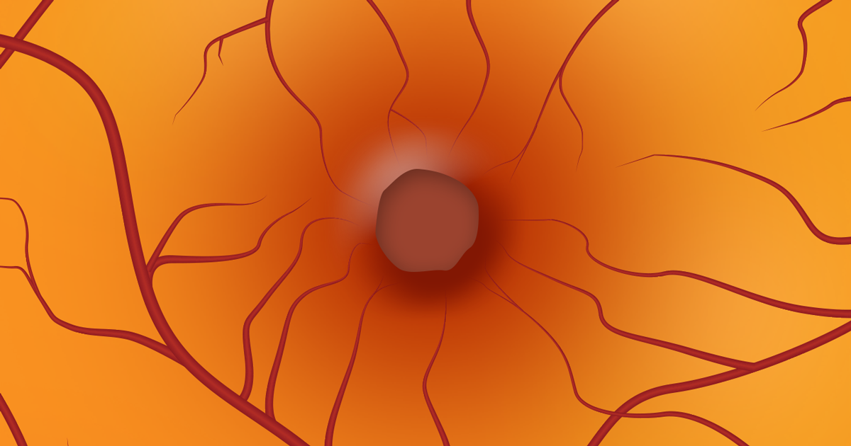 Trous maculaires : Causes, progression et chirurgie