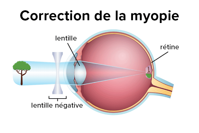 Comment corrige-t-on la myopie ?