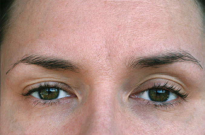 Ptosis (ptôse palpébrale) : causes des paupières tombantes