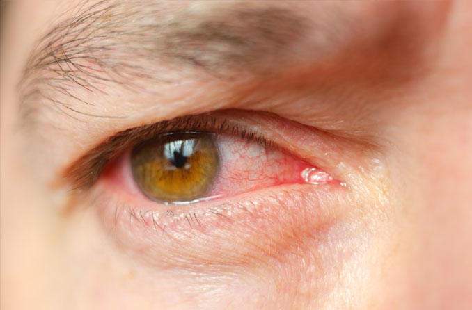 Infections oculaires : Types, symptômes et traitement | All About Vision