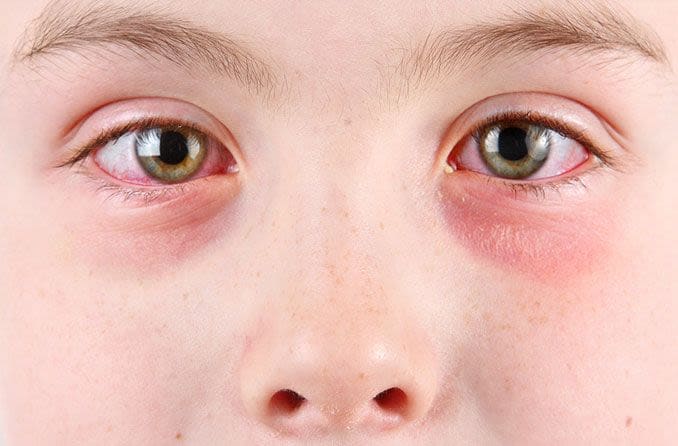 Conjonctivite (Oeil rose) Traitement et diagnostique