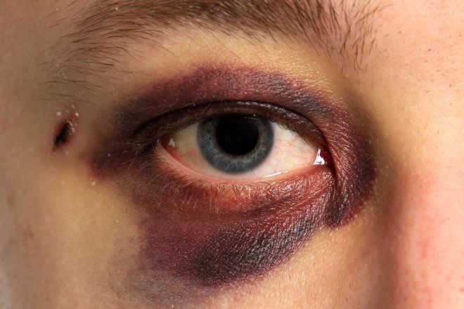 Blessures oculaires, comment réagir ?