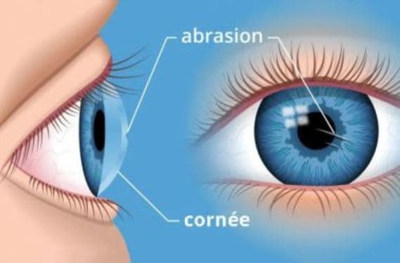 illustration d'une abrasion cornéenne