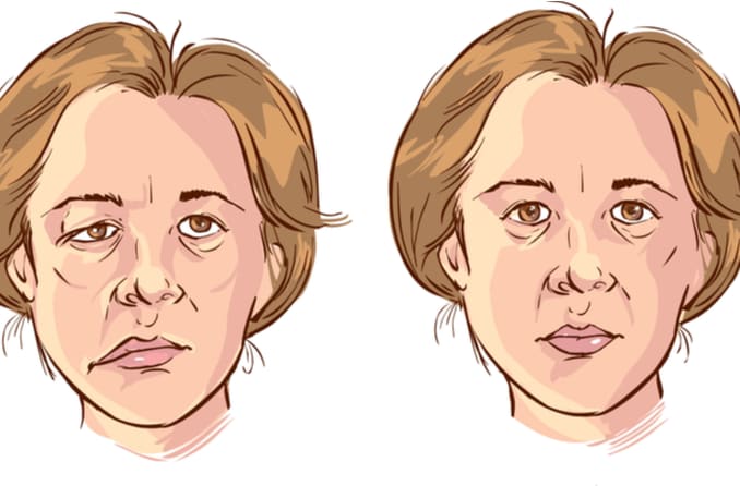 Paralysie Faciale (ou paralysie de Bell) : quelles conséquences sur l’œil ?