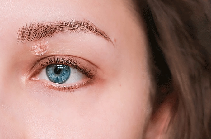 Psoriasis sur la paupière : que faire ?