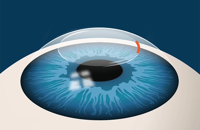 Chirurgie oculaire SMILE : correction de la myopie