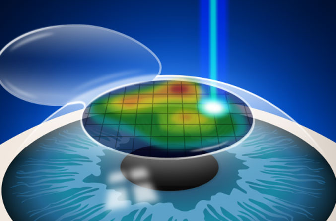 LASIK : la correction personnalisée de votre vue