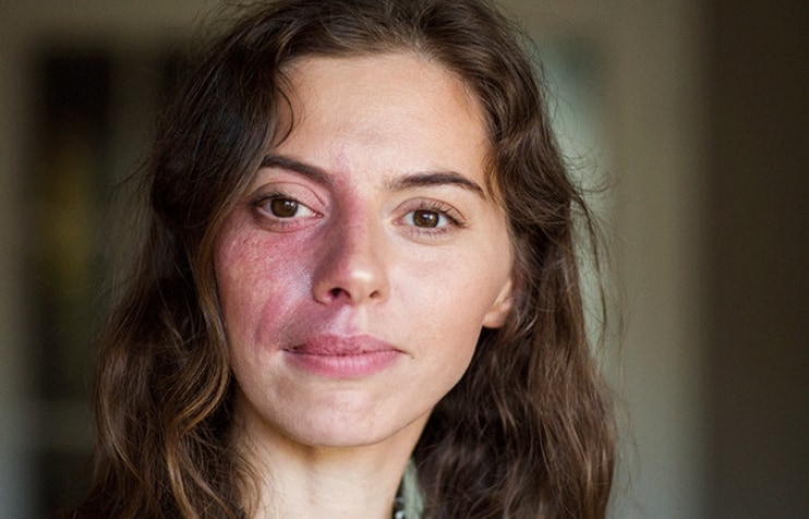 Woman with Sturge-Weber syndrome. Woman with Sturge-Weber syndrome.