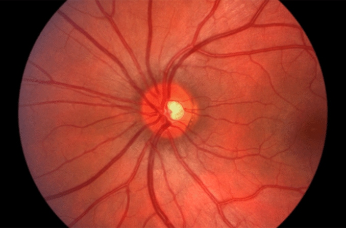 Optik Nörit ve nöropati: Nedenleri, belirtileri ve tedavileri