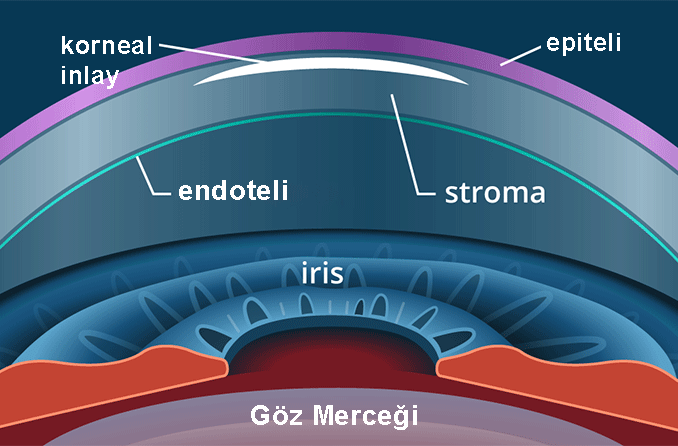 Presbiyopi ameliyatı ve monovizyon LASIK