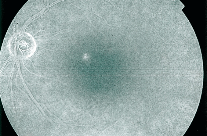 O que é coriorretinopatia serosa central (CSCR)?