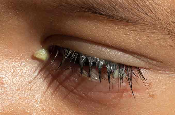 Secreção ocular: Causas da remela nos olhos