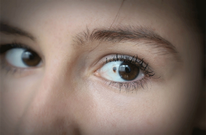 Melanoma ocular
