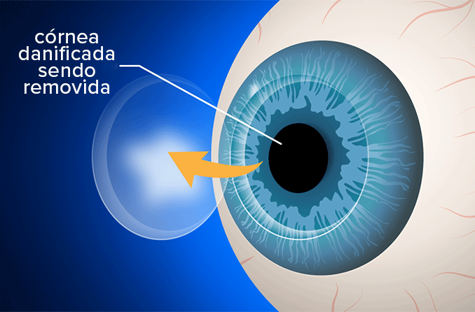 Cirurgia de transplante de córnea (ceratoplastia)